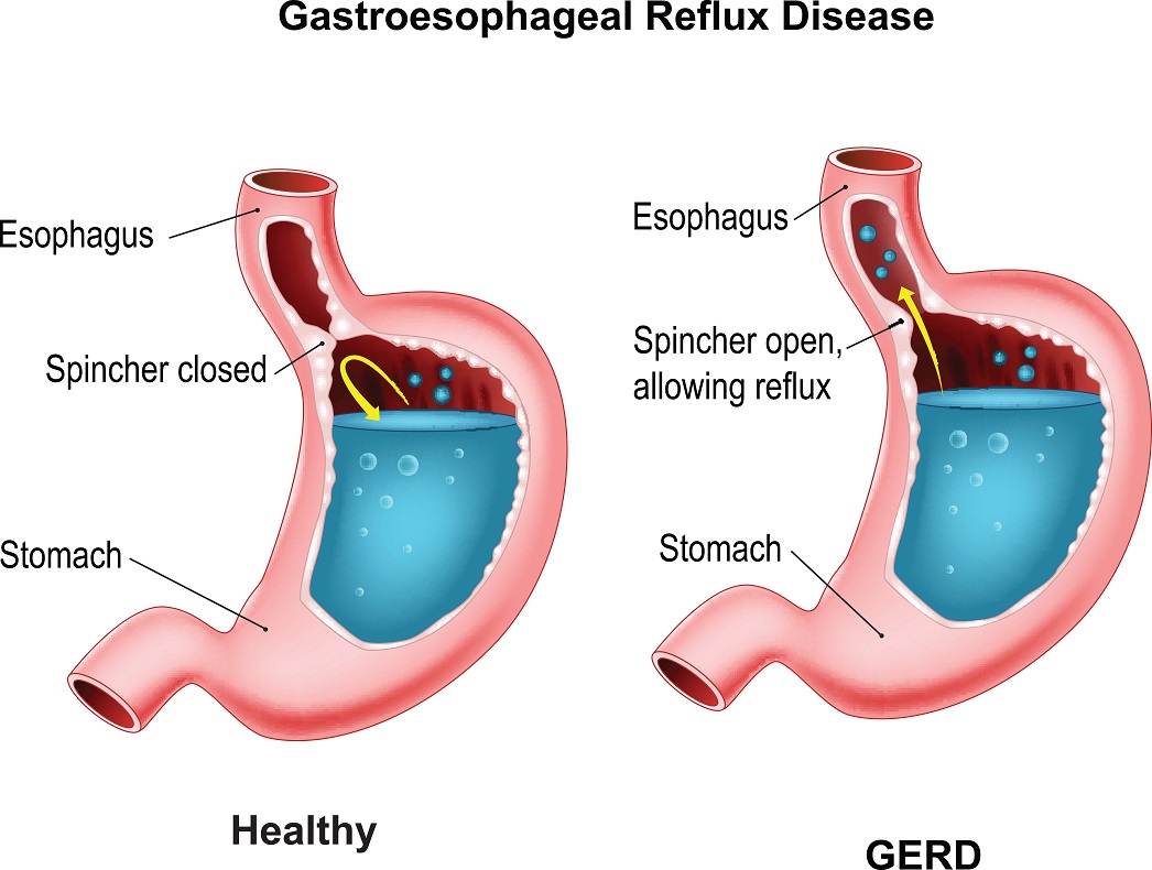 Gastrointestinal Reflux Disease